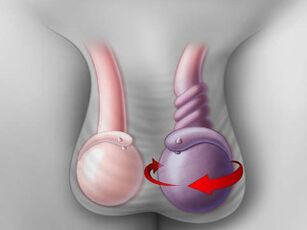 La torsión testicular como causa del dolor